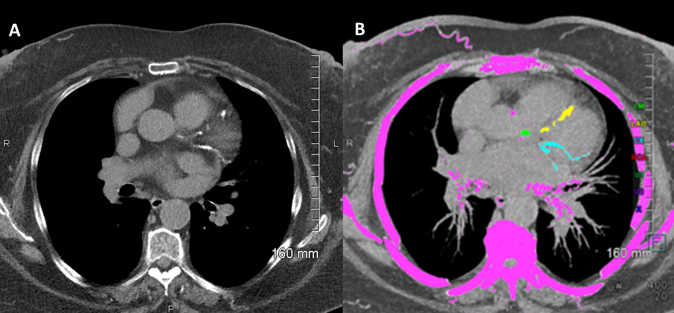 Image Analysis: Understanding Your CAC Score
