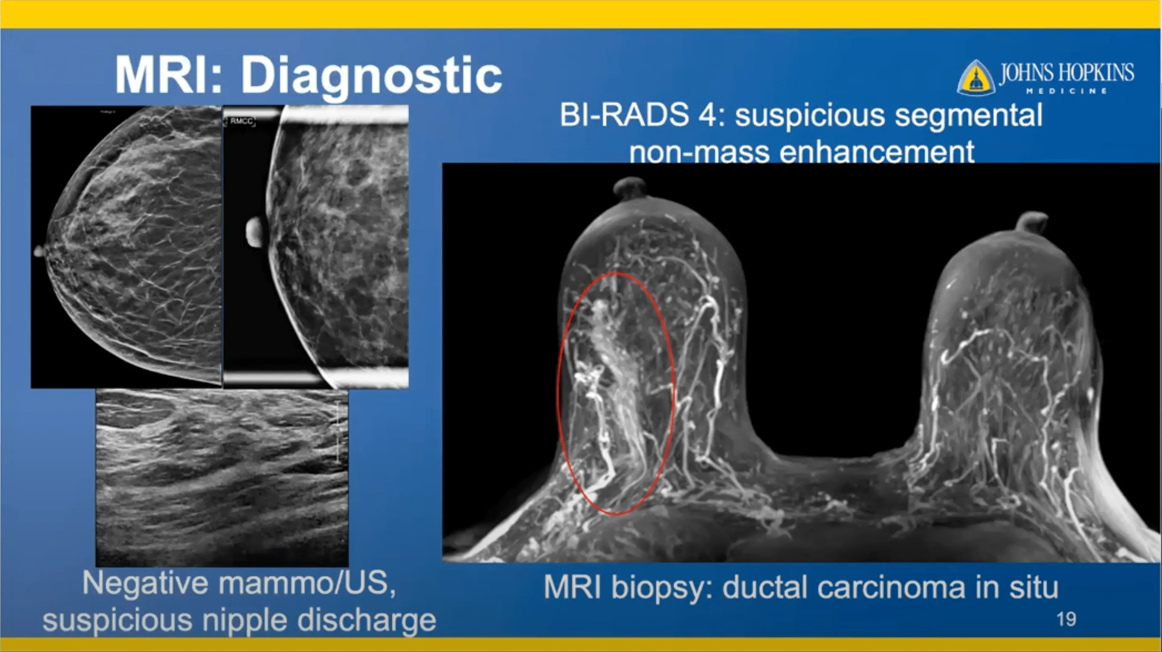 Breast MRI